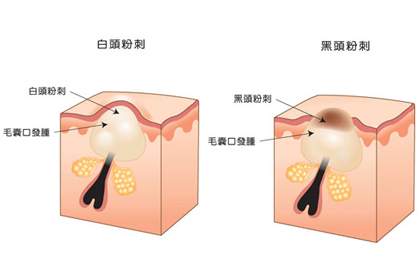 白头粉刺是怎么产生的，