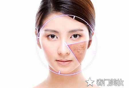 治痤疮也有技巧，专家教你如何防痘去痘