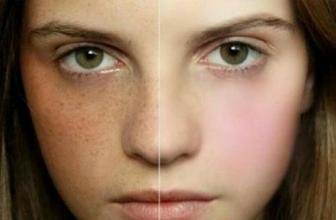 土豆淡斑的技巧