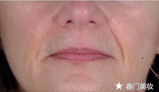 去除法令纹的小妙招