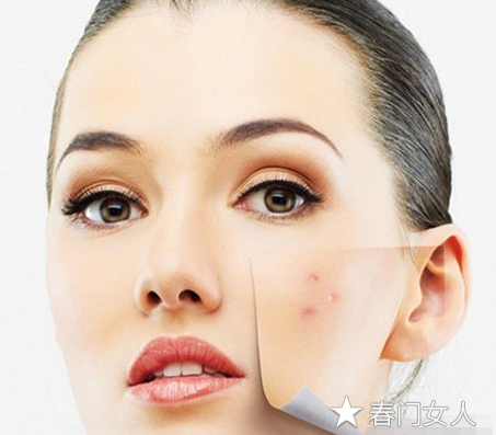 祛痘不留痘印的技巧