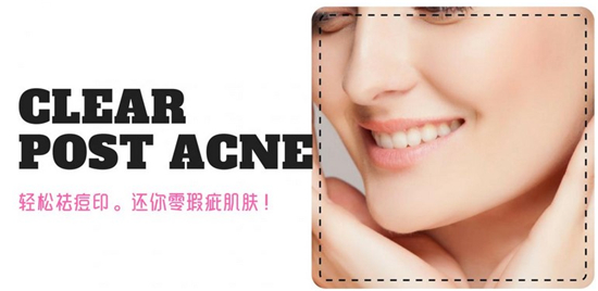 万年老痘印终于不见了，好用的祛痘去痘印产品排行榜10强