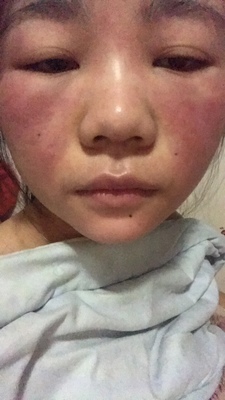 毁脸了投诉无门我来发帖,你你nini面膜激素含量严重超标 激素面膜 第2张 毁脸了投诉无门我来发帖,你你nini面膜激素含量严重超标 激素面膜 第2张