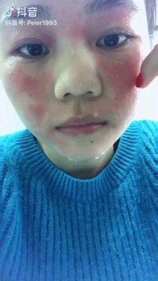 毁脸了投诉无门我来发帖,你你nini面膜激素含量严重超标 激素面膜 第3张 毁脸了投诉无门我来发帖,你你nini面膜激素含量严重超标 激素面膜 第3张