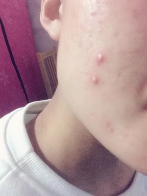 仟花佰草面膜怎么样，用完脸上就爆痘 怀疑有激素