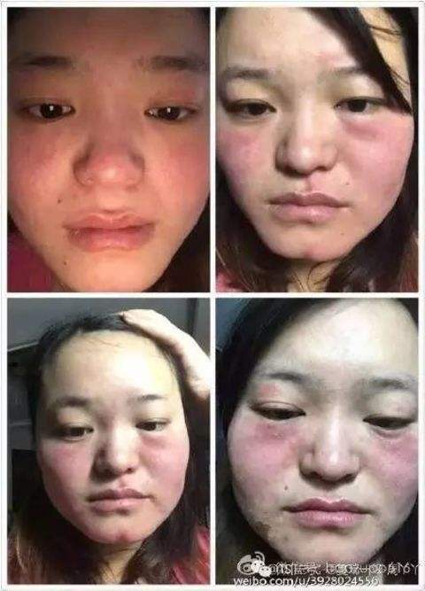 tst庭秘密微商是骗局吗，tst庭秘密烂脸毁容是真的吗