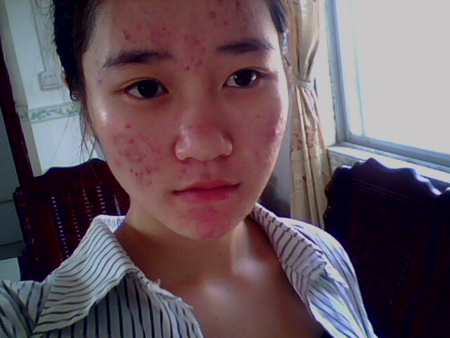 淘宝上的恩家祛痘效果怎么样，激素抗生素都用了上  祛痘激素 第2张