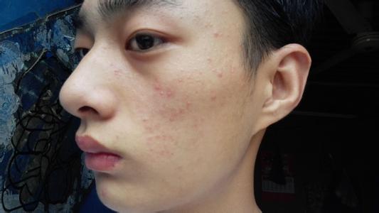 自然堂的护肤品怎么样，用了几天毛孔粗大还长痘痘