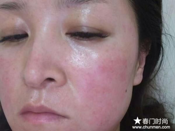 菲姿蔓妮面膜激素超标，让我几乎毁容 我该到哪里去维权