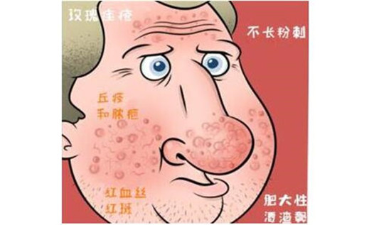 玫瑰痤疮好转的具体表现都有啥