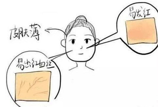 玫瑰痤疮好转的具体表现都有啥  玫瑰痤疮 美白祛黄 第3张