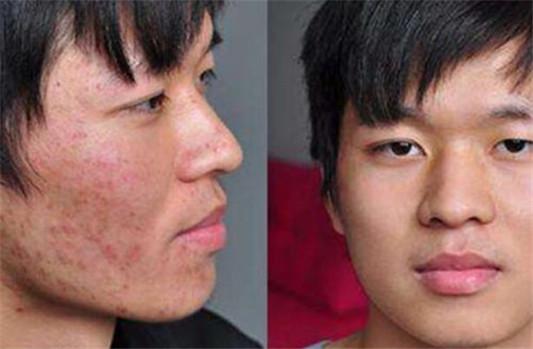 玫瑰痤疮好转的具体表现都有啥  玫瑰痤疮 美白祛黄 第4张