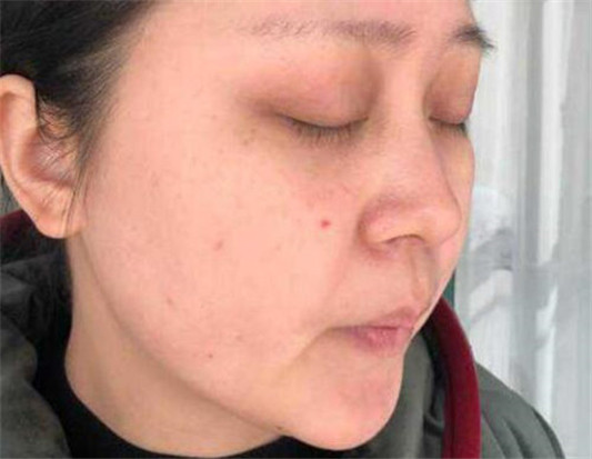 玫瑰痤疮好转的具体表现都有啥  玫瑰痤疮 美白祛黄 第5张