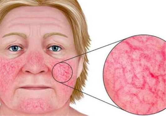 玫瑰痤疮一般多久能好，不治会自愈吗