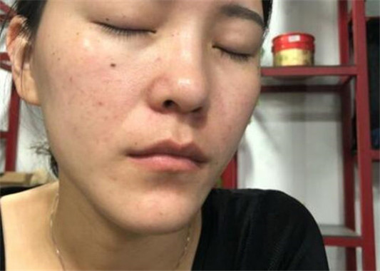 玫瑰痤疮一般多久能好，不治会自愈吗  玫瑰痤疮 美白祛黄 第2张