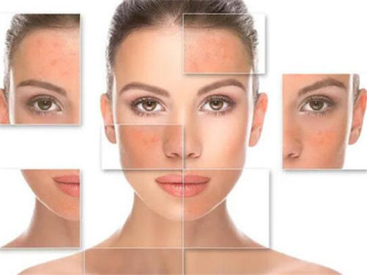 玫瑰痤疮一般多久能好，不治会自愈吗  玫瑰痤疮 美白祛黄 第3张