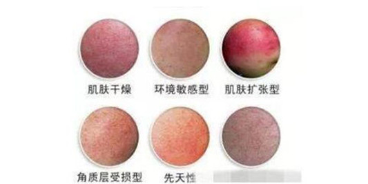 屏障受损变成玫瑰痤疮怎么修复  玫瑰痤疮 美白祛黄 第2张