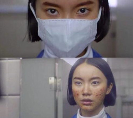 戴口罩闷痘可以用红霉素软膏吗