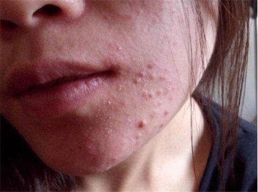 戴口罩下巴长一堆疙瘩怎么办