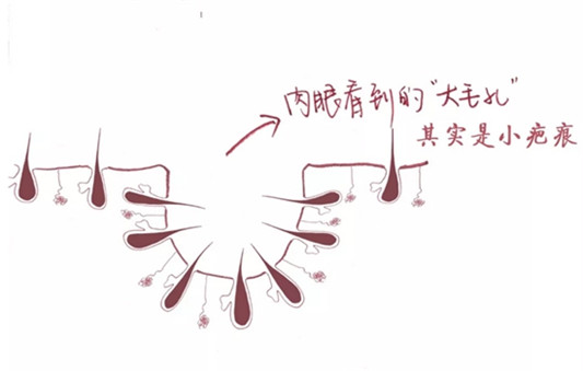 油皮毛孔粗大用什么水乳，控油抗炎是关键  控油 毛孔粗大 第9张