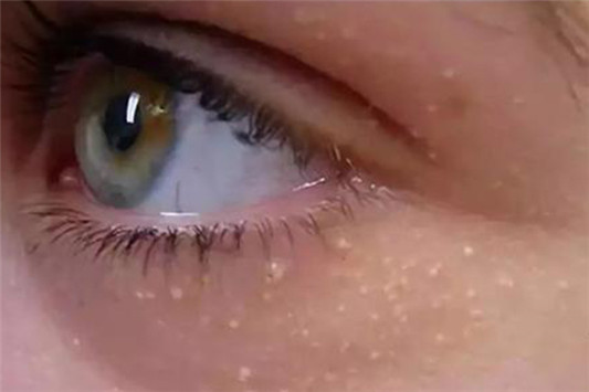 维生素E去脂肪粒步骤 维生素E 第3张