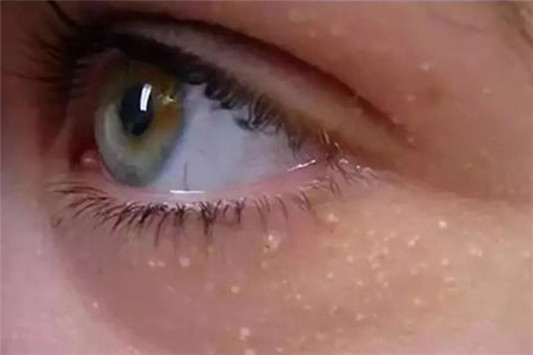 去脂肪粒的药膏 白云山盐酸金霉素 眼膏 第2张