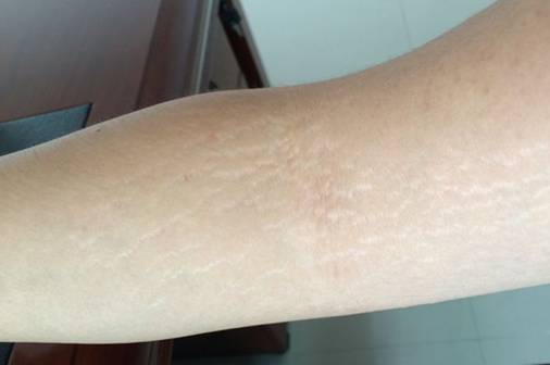 橘皮纹和肥胖纹都有什么区别 橘皮纹 肥胖纹 美妆 第1张