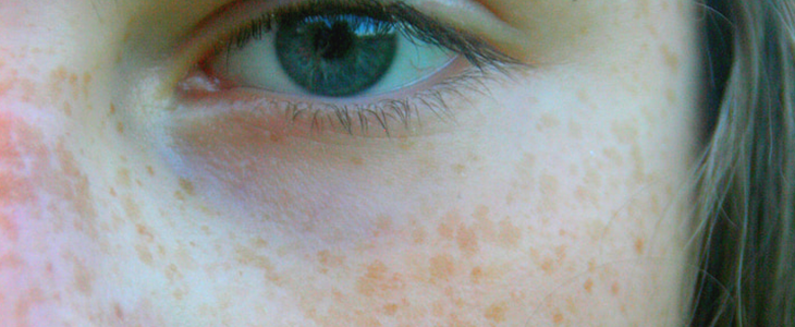 黄褐斑怎么回事 黄褐斑 美妆 第2张