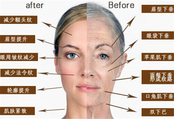 超声刀美容能维持几年，超声刀美容能维持多久 护肤 第1张