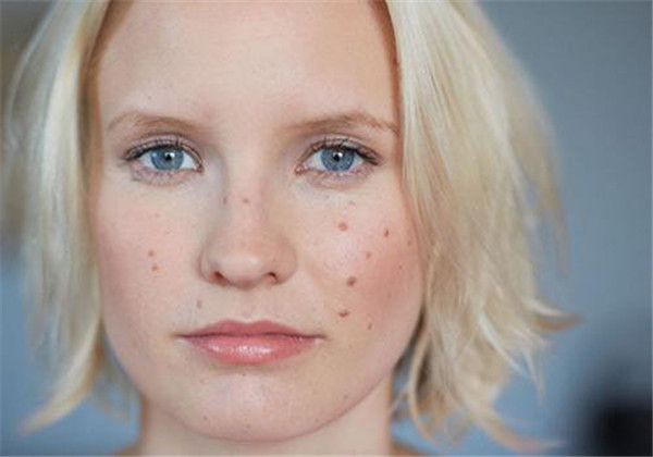 夏季长痘的原因，6大原因让你夏天一直长痘 护肤 第1张