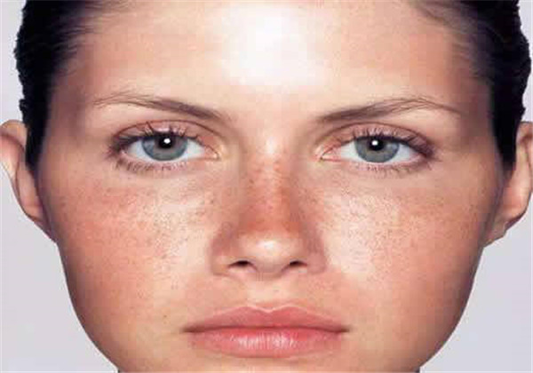 激光祛斑后反黑怎么办 护肤 第3张