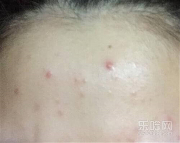 压力大额头长痘怎么办 护肤 第3张