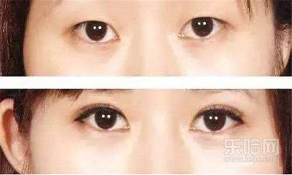 双眼皮埋线和全切哪个好 护肤 第3张