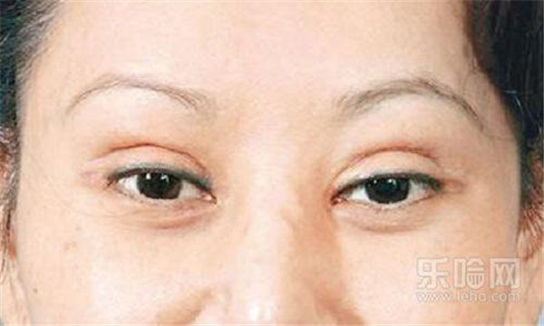 双眼皮埋线和全切哪个好 护肤 第4张