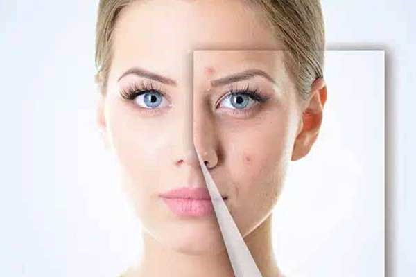 脸上长的红的硬闷痘要怎么去，可以使用红霉素吗 痘痘 第2张