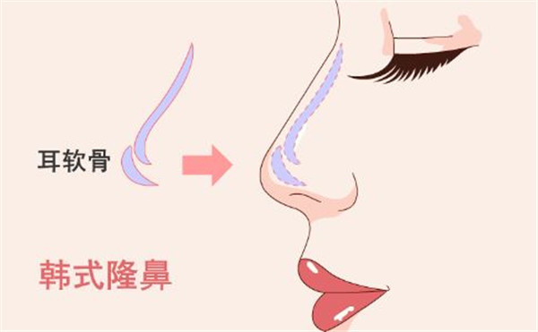 鼻头鼻翼如何缩小，鼻头鼻翼缩小效果明显吗 鼻头 鼻翼 第1张