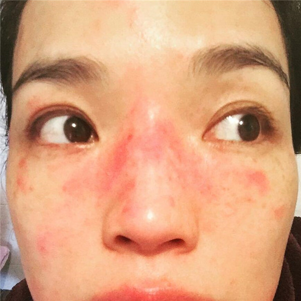 如何分辨「玫瑰痤疮」与「暗疮」，玫瑰痤疮常见4大病发阶段 玫瑰痤疮 暗疮 第8张
