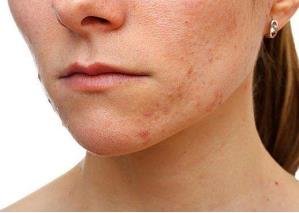 用化妆品脸过敏了怎么办最快方法，擦化妆品过敏了脸痒肿怎么办