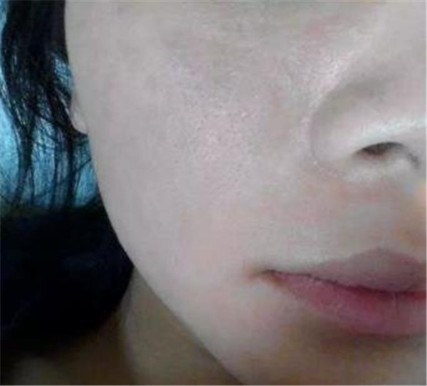 脸起皮干燥紧绷刺痛发红，皮肤干燥起皮发红刺痛怎么办