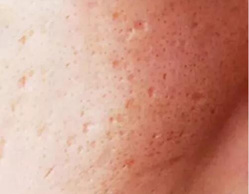 ​芦荟胶可以平坑吗，痘坑修复要靠这4个方法