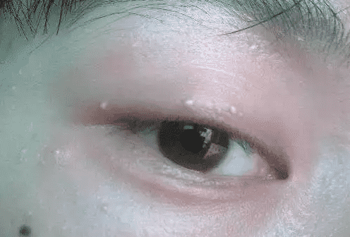 眼霜用了长脂肪粒？，眼霜表示不背这个锅