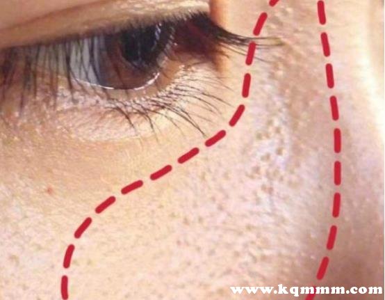 毛周角化脸颊两侧红怎么去红，脸部怎样去除毛周角化