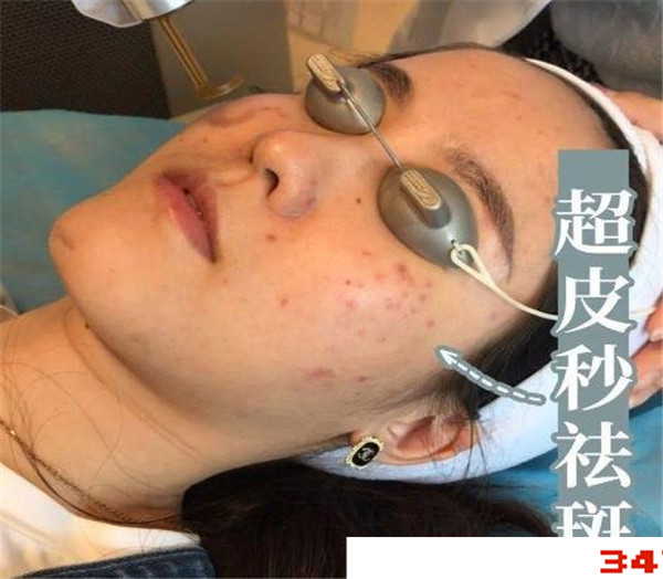 光子嫩肤和超皮秒哪个效果好，先做皮秒还是先做光子嫩肤