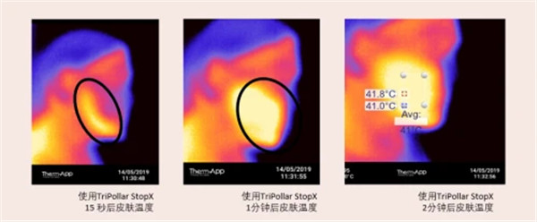 揭秘射频美容仪功效：初普TriPollar如何平衡射频“有效能量”和“智能安全”