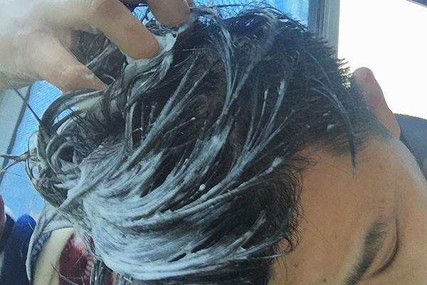 为什么头皮上总能摸到小疙瘩影响健康吗