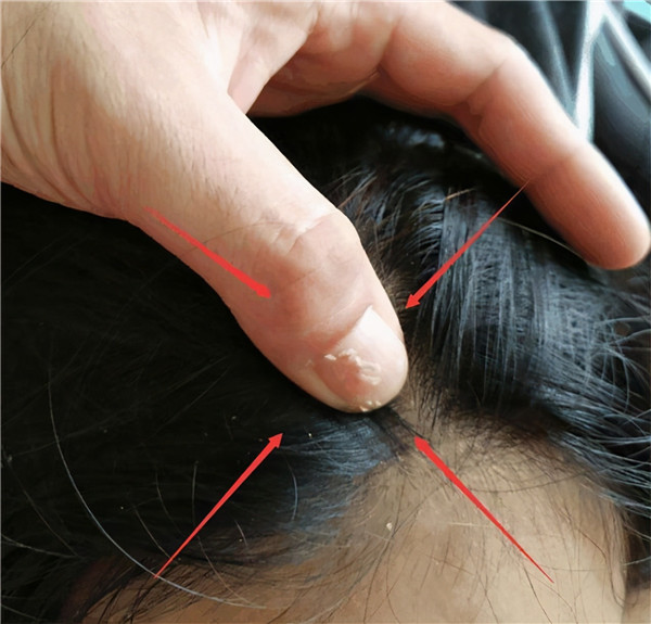 头上抠下的「白泥」，居然不是头皮屑那是什么