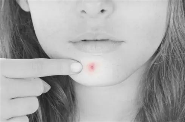 为什么皮肤同一位置会反复长痘，怎么消除