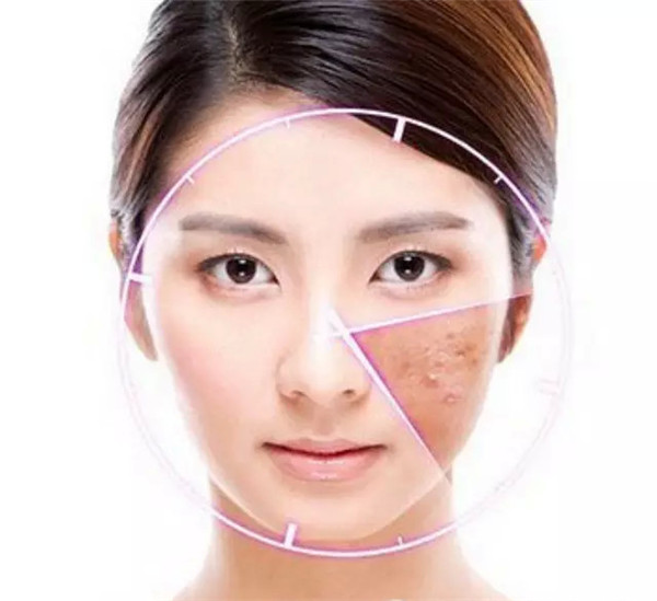 消灭痘痘，重返婴儿肌肤