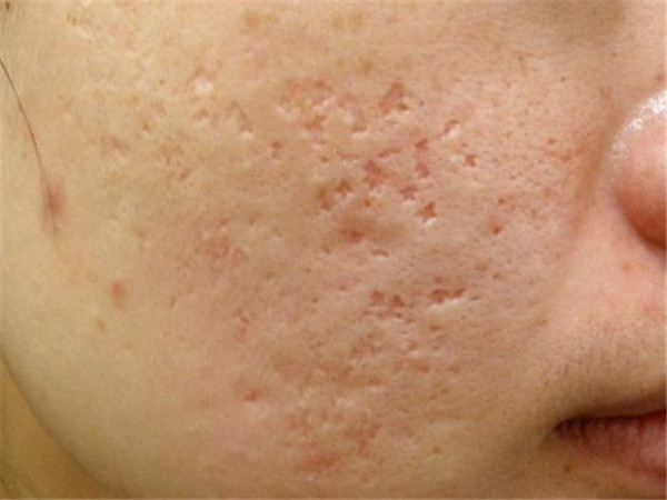 消灭痘痘，重返婴儿肌肤