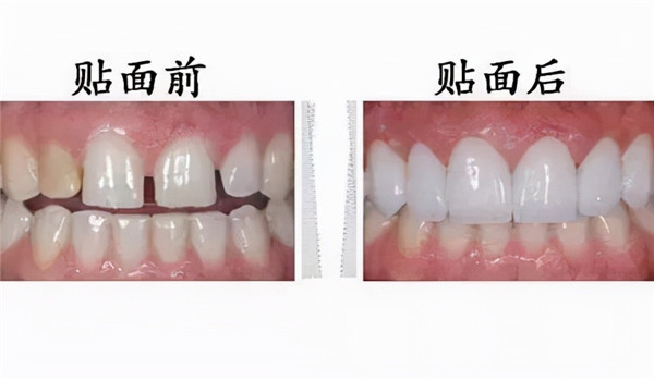 牙齿为什么越来越黄?常见的三种美白方式了解一下